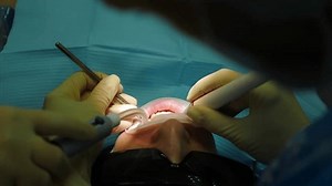 Mundhygiene. Ultraschall-Zahnreinigungsmaschine zum Entfernen von Zahnstein: Stockvideos & Filmmaterial (100 % lizenzfrei) 3973038509 | Shutterstock