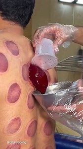 🏆 Hijama (Wet Cupping) Therapy Hijama, also known as wet cupping, is a traditional healing practice where small incisions are made in the skin before applying suction cups to draw out a small amount of blood. This technique is believed to remove “stagnant” blood and toxins, stimulate circulation, and encourage the body’s natural healing processes. Practiced for centuries in various cultures, hijama is used today to support relief from chronic pain, inflammation, migraines, fatigue, and more. Ma