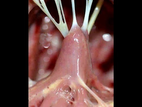 Chordae tendineae (tendinous chords)