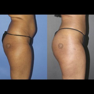 11 reactions | Target area: Buttocks Treatment: Brazilian Butt Lift...