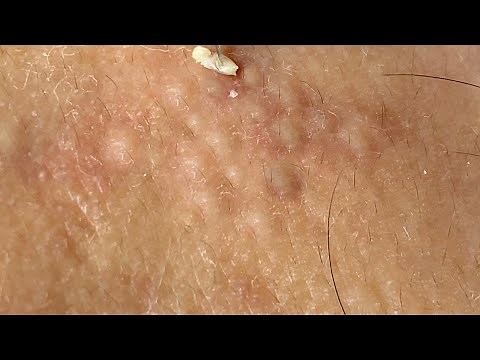 Acne Streatment With Sac Dep Spa #02