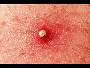 Zit Popping on leg