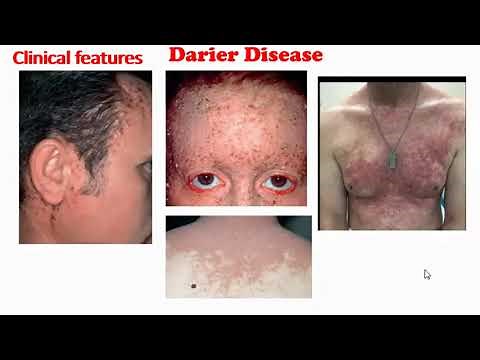 Darier Disease