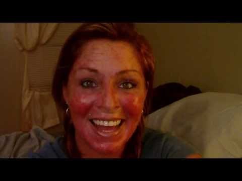 Skin Cancer..... My Vlog w/ EFUDEX Video Journal #12