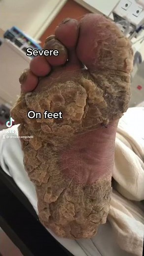 Severe Callus removal in operating room #Shorts