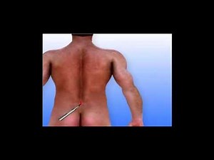 Lumbar Laminectomy Surgery Animation