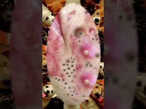 Huge blackhead removal from nose/ old aged blackheads removal/ cystic blackheads whiteheads removal