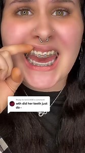 12K views · 49 reactions | That awkward moment when your tooth just taps out  #DentalTips #HealthySmile #FunnyDentist #BracesOff | TheBentistofficial | Facebook
