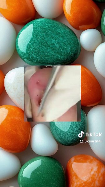 Understanding Ingrown Toenails and Their Removal