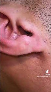 Basem with remove black heads