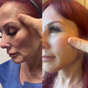 Transforming the Look: Stunning Before & After Results of a Facelift, Brow Lift, and Fat Transfer 🔥 | Dr. Kamran Khoobehi