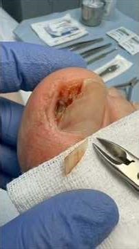 Deep Ingrown Toenail Extraction 😳 – Severe Onychocryptosis #shorts