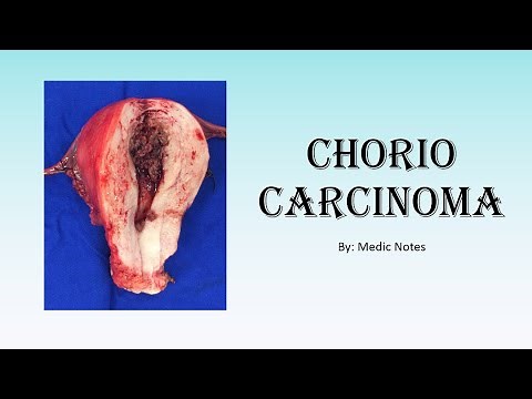 [O&G] Choriocarcinoma - s&s, investigation, treatment, FIGO staging, WHO prognostic score