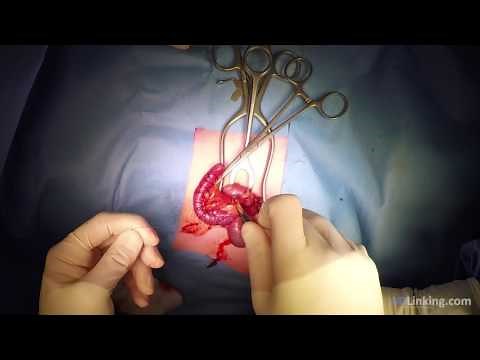 Appendectomy (open procedure)