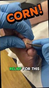 Kent the podiatrist here, removing a painful corn from the lateral sulcus of the fourth toe using a