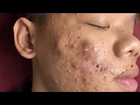 Make your Acne Treatment Huong Da Nang | 448# Hoang Part 3 | acne 2022
