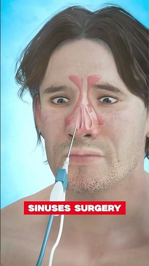 The truth about Sinus Surgery - #SinusSurgery #entspecialist #healthawareness