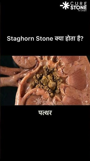 what is Staghorn kidney stone ? #urology #rirs