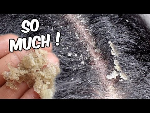 MY BEST FLAKES EVER!!!!! | Scalp scratching and picking | Satisfying Dandruff Removal ASMR