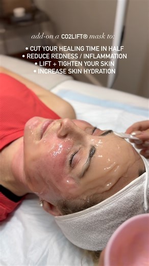 GENIUS RF MICRONEEDLING CO2LIFT MASK | Lutronic Genius® facilitates the regeneration of collagen and elastin through coagulation, ideal for mitigating scars, skin texture, wrinkles, and laxity across the body. Through uninterrupted impedance monitoring, each delivered pulse is enhanced and the precise energy imparted to tissue is ascertained for long-term visible results. CO2LIFT® Carboxy Gel Treatment effectively... - Reduces fine lines and wrinkles - Increases hydration to recapture the skins 