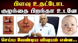 பிறவி பிளவு உதடு, பிளவு அண்ணப் பிரச்சினைக்கு நவீன சிகிச்சை | plastic...