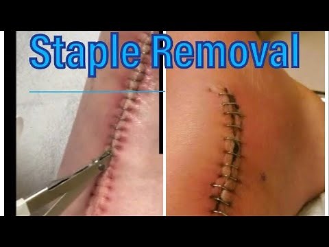 Staple Removal after surgery and your common questions answered! | Broken Ankle 101 Series