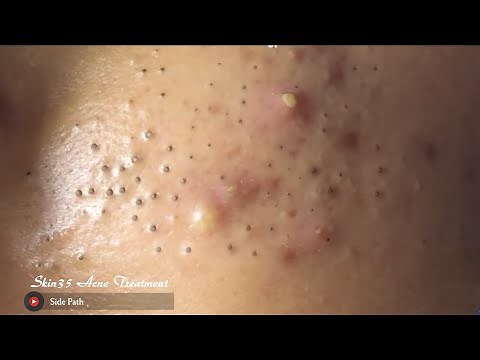 Tokyo Acne Treatment Blackhead Extractions Popping #5