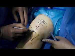 Primary Quadriceps Tendon Suture Anchor Repair