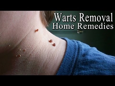 Warts - 5 Simple Home Remedies to Get Rid of Facial Warts Naturally |