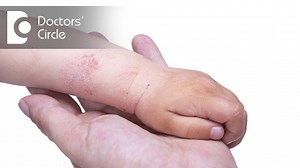 How to manage Atopic Dermatitis in children? | Doctors' Circle