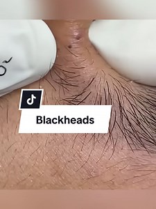 #acnetreatment #satisfyingvideos #foryou #blackheadsss #blackheadsremover