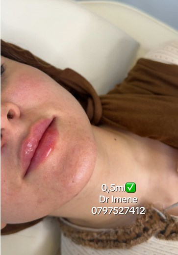 Lip Enhancement with Restylane: Dr. Imene