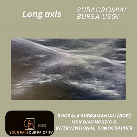 subacromial bursa Ultrasound guided injection