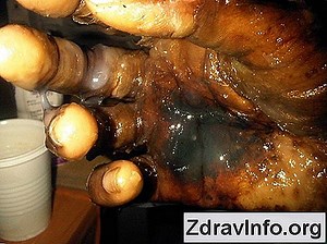 Oční kapky Dexamethason - návod k použití. Odstraňuje zánět 👃👃 Portál Sinus A Další. - 2025