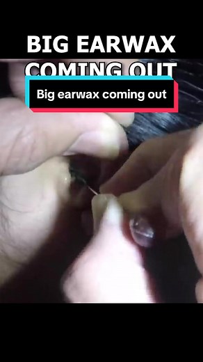 Big earwax coming out.. #earcleaningvideos #earwaxremoval #limpezadeouvido #earwaxcleaning #ceradeouvido