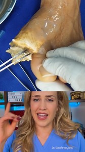 98K views · 300 reactions | Watch until the end for the diagnosis! #Doctor #doctorreacts #doctorsoftiktok #learnsomethingnew #medical #surgery #medicalvideos #doctors #podiatry #podiatrist #footsurgeon #surgeon #surgeons #nurse #nurses #healthcare #scrublife #medicalhumor #scrubslife #podiatric #medicine | Footdocdana | Facebook