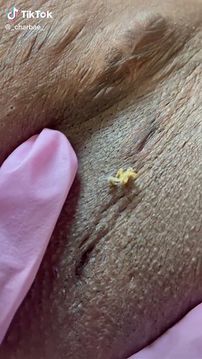 UnderArm—EXTRACTIONS #ingrownhair #ingrownremoval #skincare #esthetician #powellspassion #extractions #edutok #pageforyou #viral #oddlysatisfying