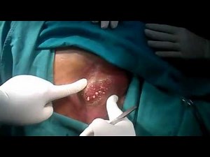 Excision of Diabetic Carbuncle upper back - 2 - Dr Narotam Dewan, Dewan Hospital, Ludhiana