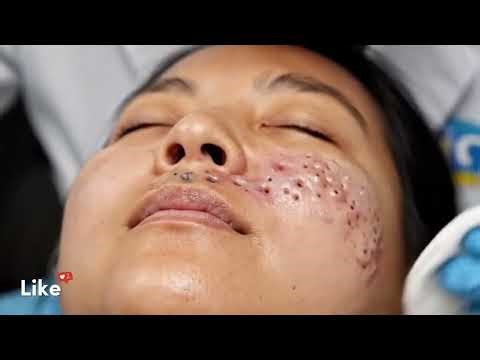 Extreme Blackhead Removal Satisfying Acne & Blackhead Extraction Deep Blackhead Removal Compilation
