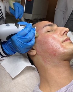 12 reactions | Infini Rfmicroneedling with PRP ✨ Call or Text to book your appointment (425)281-4325 #naturalrejuvenationmedspa #medspa #lasemd #rfmicroneedling #prp #pdothreadlift #skintightening #seattlemedspa #bellevuemedspa #naturalrejuvenation #beauty #skincare #skincareroutine #skin #flawlessskin #nonsurgical #nonsense #infini #isclinical #isclinicalbellevue #isclinicalseattle #natural | Natural Rejuvenation MedSpa | Facebook