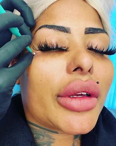 #dermalanchor on camera 🔥 .. .. .. #indiapiercing #piercingmalmö #girlswithpiercings #piercingstudio #pierced #dermalanchor #piercingskåne | India piercing