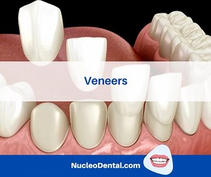 Veneers are very thin shells made of porcelain or resin composite materials, and they're bonded to the fronts of your natural teeth to cover up flaws. . Phone: 915 308 0101 nucleodental.com . #NucleoDental #ElPasoTx #CiudadJuarez #NewMexico #dentalclinicnearme #oralcare #oralhealth #dentaltourism #dentaltourismmexico #dentalimplantsmexico #dentalimplantsjuarez #bestdentalserviceintown #cosmeticdentistry #dentalservice #orthodonticservice #fullmouthrehabilitation #americaninsurance #transportatio