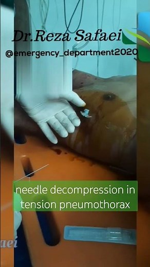 needle decompression in tension pneumothorax #Pneumothorax #explore #chest #thoracostomy #نموتوراکس
