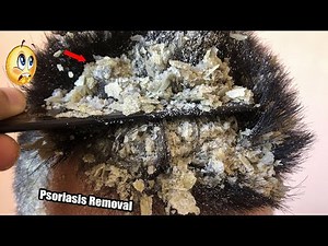 Huge flakes dandruff removal off big flakes || ASMR Scratching #803