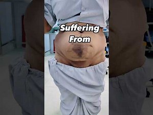 🚨 Big Hernias? Discover the Game-Changing TAR Surgery! 💪🩺 | Facts, Steps & Benefits
