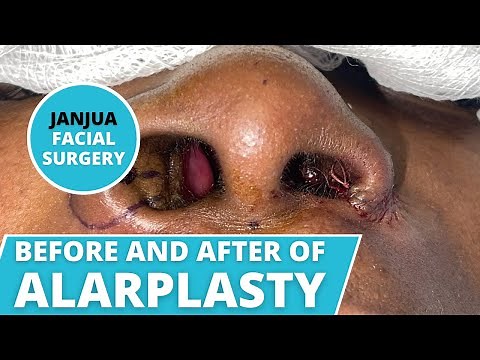 ALARPLASTY (NOSTRIL NARROWING) BEFORE AND AFTER - DR. TANVEER JANJUA - NEW JERSEY