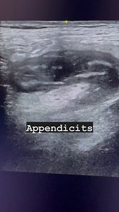 22 reactions | Appendicitis #appendix #appendicitis #appendixultrasound #ultrasoundmadeeasy | Ultrasound made easy | Facebook
