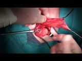 Open Inguinal Hernia • Video • MEDtube.net
