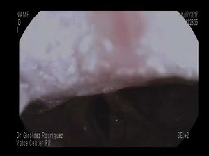 Vocal Fold Injection Augmentation