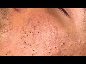 [ASMR] Deep Cleansing Pores, Satisfying Blackhead Removal, Facial Care By Dr. Pimple Popper